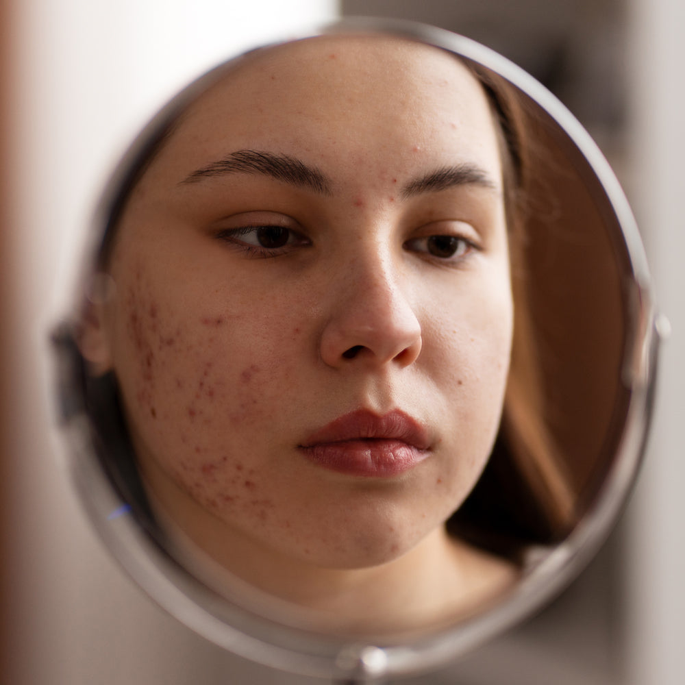 Acne-Friendly Makeup Tips: Enhance Your Beauty Without Compromising Your Skin Health