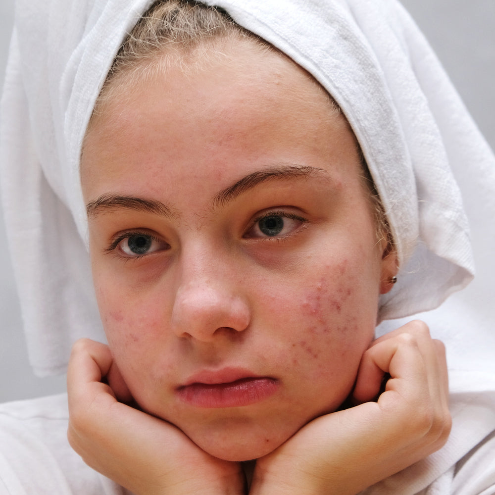 Common Mistakes in Acne Skincare Routines: The Importance of Moisturizing and Maintaining a Healthy Skin Barrier