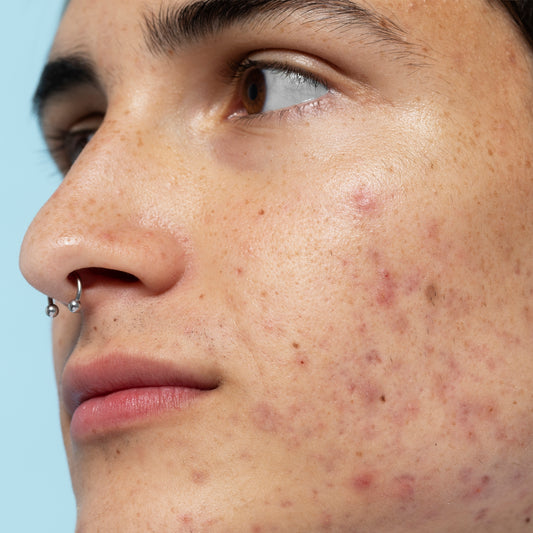 Niacinamide: Your Skin's Secret Weapon for Tackling Rosacea, Acne, and More!